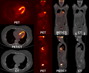 PET-CT scan of the lungs with a tumour necrosis.